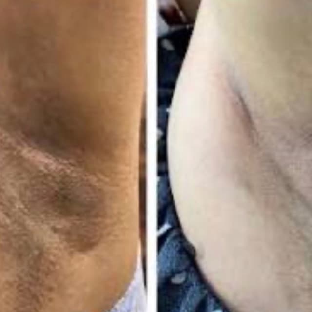 Underarm Brightening Treatment at Ana Aesthetic & Beauty in Freeport, NY